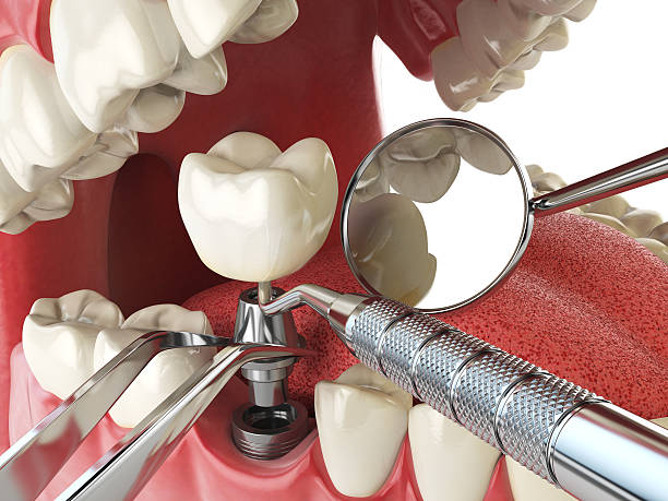 Best Emergency Tooth Extraction in North Little Rock, AR